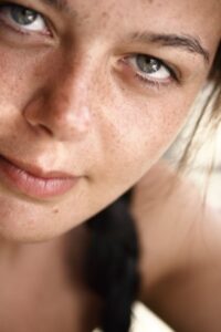Acne Scars Treatment
